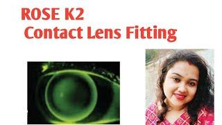 ROSE K2 Contact lens fitting basics for mild to moderate Keratoconus