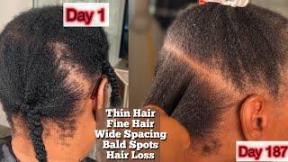 THIN HAIR PROBLEMS  Let’s fix it ! |Fine thin Hair with Bald Spots : Her 1st Year CASE STUDY