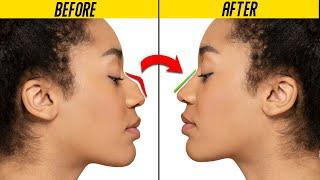 Is Rhinoplasty Right for You? Discover the Real Results!