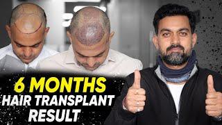 Hair Transplant in Surat | Best Results & Cost of Hair Transplant in Surat