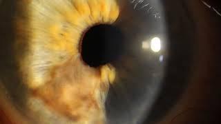 Iris Melanoma 3D Growing Inside Eye