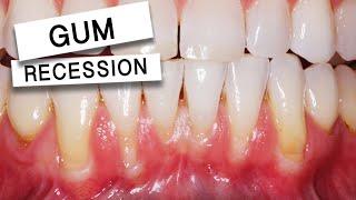 LOOSE TEETH From Gum Recession - TIGHTENED UP with The Pinhole Technique