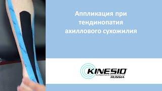 Кинезиотейпирование. Тендинопатия ахиллового сухожилия