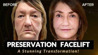 SPECTACULAR FACELIFT RESULTS - Preservation Facelift - By Dr. O'Daniel