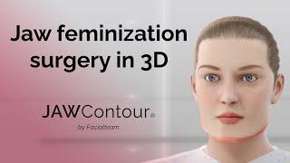 JAWContour® | 3D Precision in Jaw and Chin Feminization Surgery