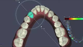Ortho Treatment Planning || Clear Moves Aligners