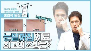 눈밑지방 필러에도 최고의 조합이 있다?  [클리니크후즈후]