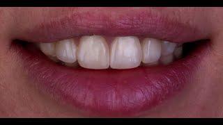 Direct Composite Veneers on a Class IV Restoration with Dr. Agne Malisaukiene