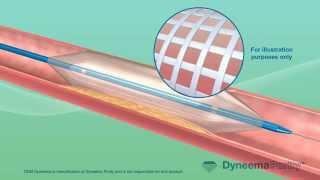 Balloon Catheter Angioplasty - Medical Animation by Watermark