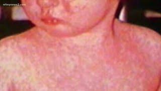 Verify: Should Older People Get The Measles Vaccine Too?