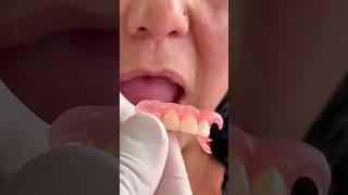 Flexible dental prosthesis without palate #mrdent #dentalesthetics #smile #yourdentist #viral