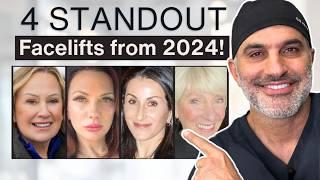 Plastic Surgeon Breaks Down 4 Incredible Facelift Before and Afters from 2024