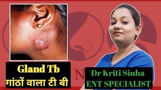 Gland Tuberculosis. गाठो वाला टी बी- कारण एवं उपाय .@SATYAEYEANDENTCARE @drkritisinha