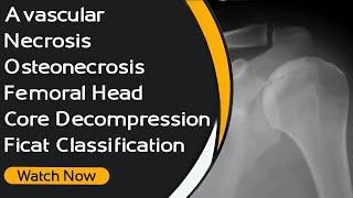 Avascular Necrosis / Osteonecrosis | Femoral Head | Core Decompression | Ficat Classification