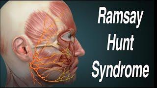 Ramsay Hunt Syndrome