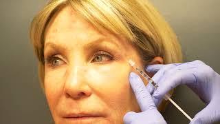 Hyaluronic Acid Fillers | Janiga MDs