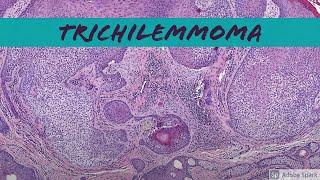 Trichilemmoma: 5-Minute Pathology Pearls