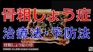 本当は怖い「骨粗しょう症」自宅で簡単にできる予防法と最新治療法【骨粗しょう症・医療のミカタ】