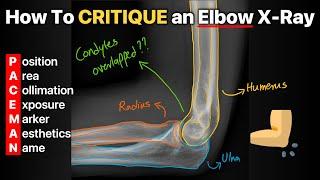 How To Critique an Elbow X Ray!