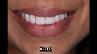 8 non-cutting veneers by Dr Aleem. Same-day placement