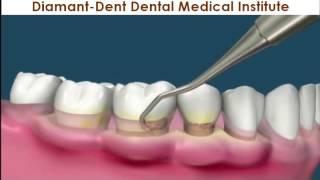 Professionelle Zahnreinigung, Diamant-Dent Zahnklinik