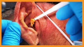 Ed's Earwax Extravaganza | Auburn Medical Group