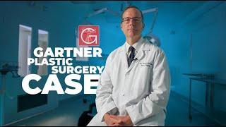 Dr. Gartner Plastic Surgery Case: Breast Augmentation