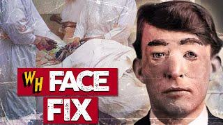 The Crazy True Story Of The First Plastic Surgery In History