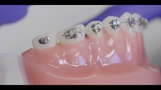 Orthodontic Emergencies And How To Manage Them