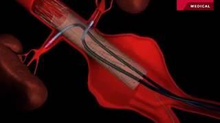 Fenestrated Endovascular Graft to Repair Abdominal Aortic Aneurysm