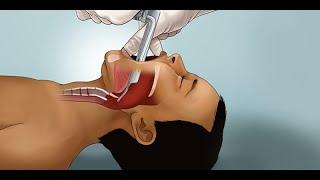 Pediatric Endotracheal Intubation by J. Nagler, et al. | OPENPediatrics