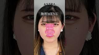 鼻フル整形ここまで変わる#アストラビューティクリニック#astrabeautyclinic #美容整形#鼻整形#忘れ鼻#垢抜ける方法