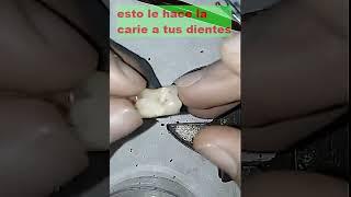 caries cavities shorts  dentist funny fun #shorts #caries #cavities  #shorts   #dentist  #funny