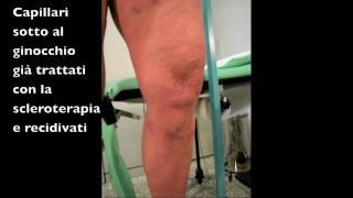 Estetica, capillari e chirurgia emodinamica - varici, vene varicose, CHIVA, veneinforma