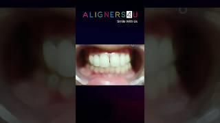 TEETH STRAIGHTENING WITH ALIGNERS4U #shorts #aligners #teeth #dental #invisalign #hyderabad #smile