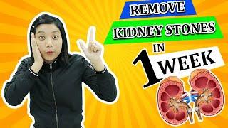 Remove Kidney Stones In 1 WEEK with Karma Ayurveda |Karma Ayurveda Hospital