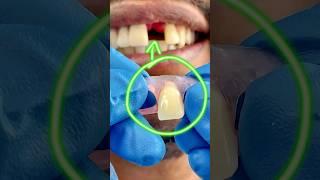 ATTENTION New FLEXIBLE TEETH  #misterdent #mrdent