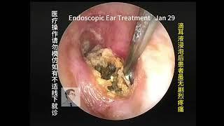 Cleaning of cholesteatoma and ear fungal removal 20240129