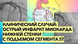Клинический случай: острый инфаркт миокарда нижней стенки с элевацией сегмента ST