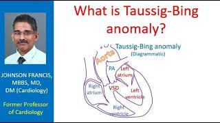 What is Taussig Bing anomaly?