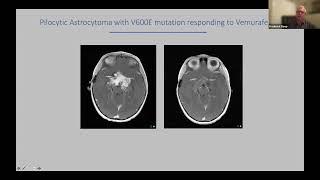 Considerations in Pediatric Supratentorial Brain Tumors