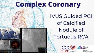 IVUS Guided PCI of Calcified Nodule of Tortuous RCA