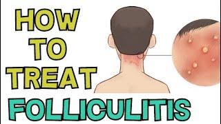 HOW TO TREAT FOLLICULITIS FAST