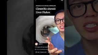  Liver critters #liverfluke #liver #parasite