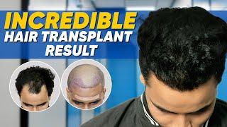 Hair Transplant in Ahmedabad | Best Results & Cost of Hair Transplant in Ahmedabad