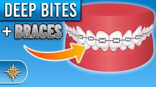 How Do Braces Fix Deep Bites? | Premier Orthodontics