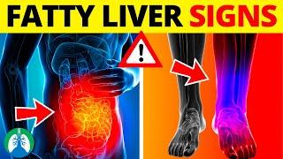  Top 10 Signs and Symptoms of Fatty Liver You MUST AVOID