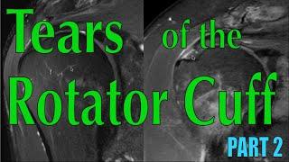 Tears of the Rotator Cuff Part 2: Identifying Tears on MRI