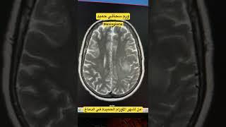 ورم سحائي حميد meningioma