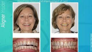 Aligner Insider- Invisalign Case Studies with special presenter Dr. William Kottemann- Part 2